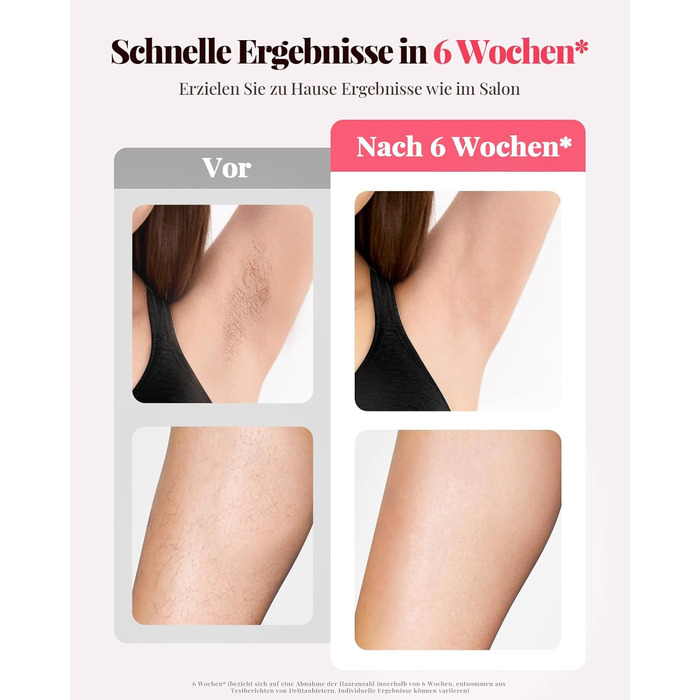 Пристрій для епіляції IPL Laser - Безболійна епіляція вдома: 9 рівнів, 999 900 імпульсів світла для тіла, обличчя та бікіні. Рожевий колір